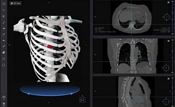 Early Detection of the COVID-19